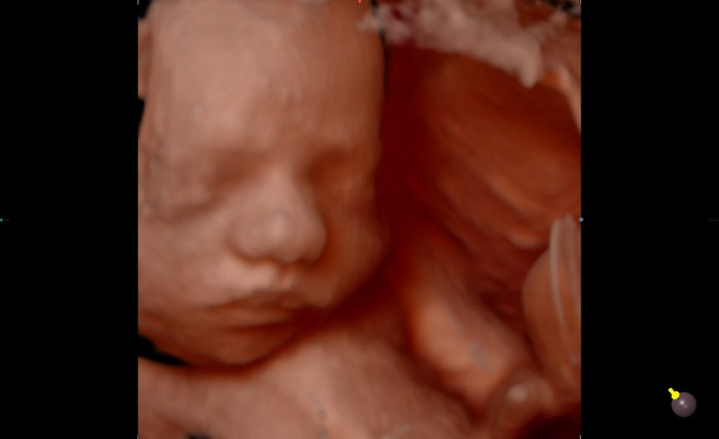 Ecografías 5D o 4D HDlive: imágenes súper realistas de tu bebé