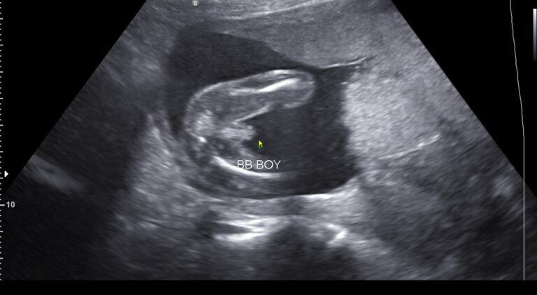 17 week 4d ultrasound pictures 17 week 4d ultrasound pictures